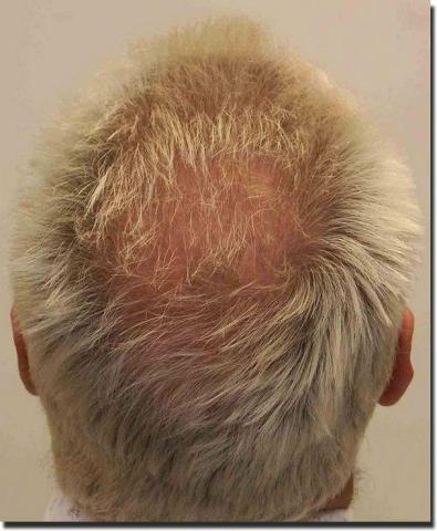 Hair restoration procedure results