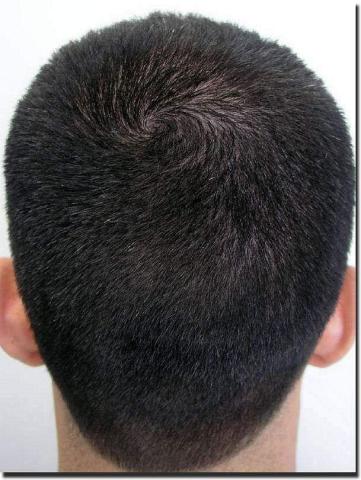 Hair restoration procedure results