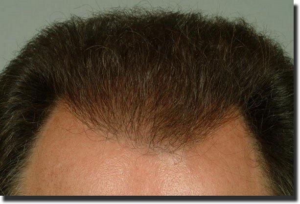 Hair restoration procedure results