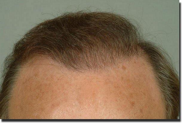 Hair restoration procedure results