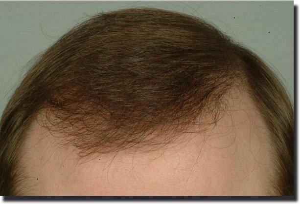 Hair restoration procedure results