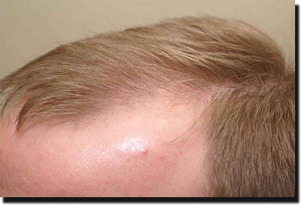 Hair restoration procedure results