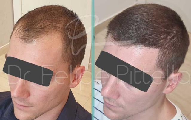 Left view before and after hair transplant surgery