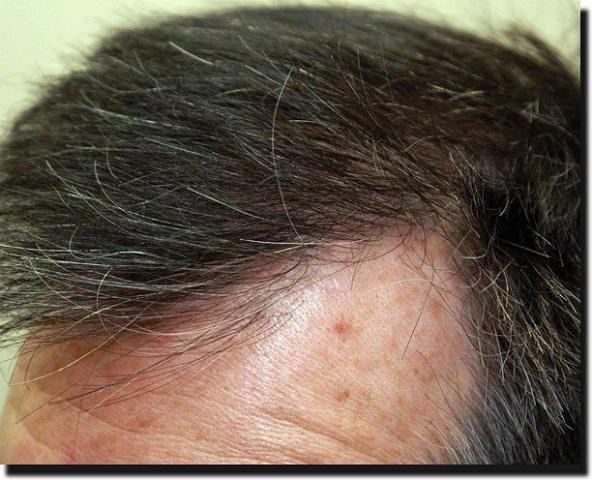 Hair restoration procedure results