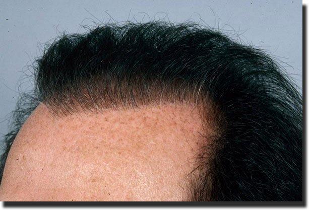 Hair restoration procedure results