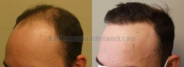 Left view before and after hair transplant surgery