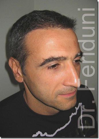 Hair restoration procedure results