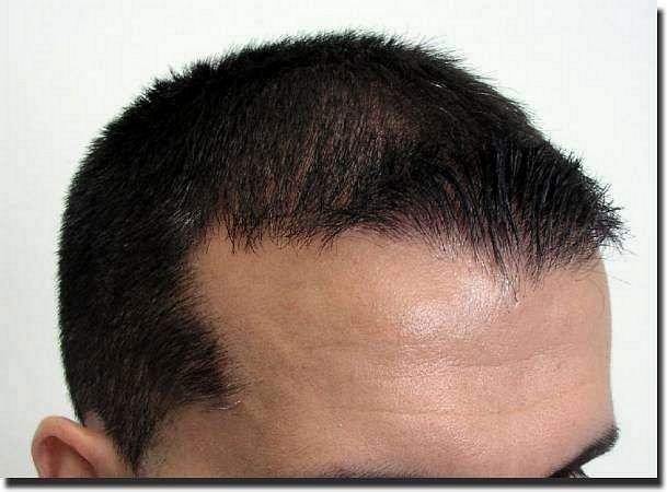 Hair restoration procedure results