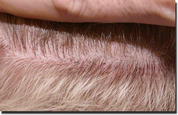 Hair restoration procedure results