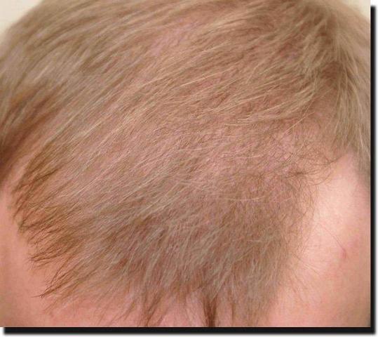 Hair restoration procedure results