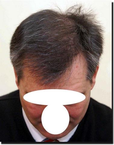 Hair restoration procedure results