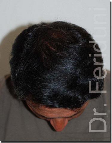 Hair restoration procedure results