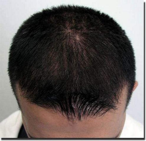 Hair restoration procedure results