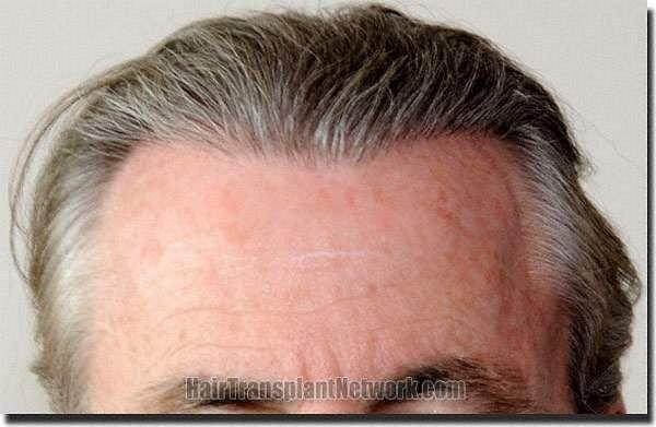 Hair restoration procedure results