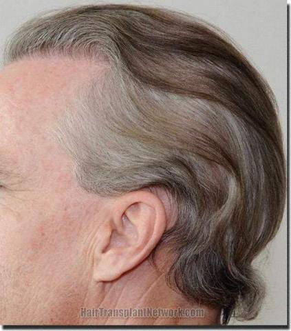 Hair restoration procedure results