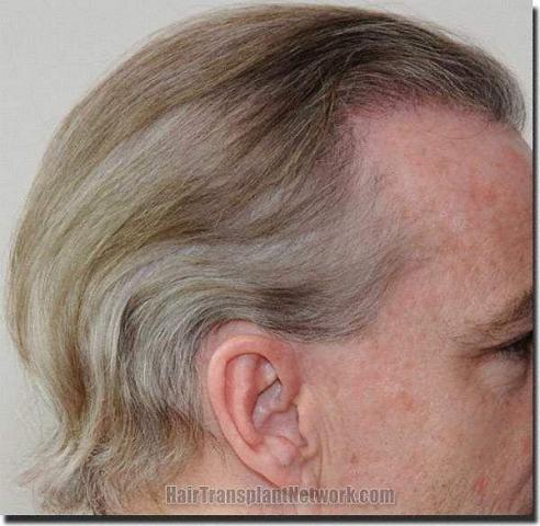 Hair restoration procedure results