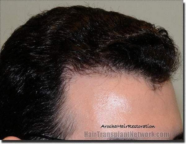 Hair restoration procedure results