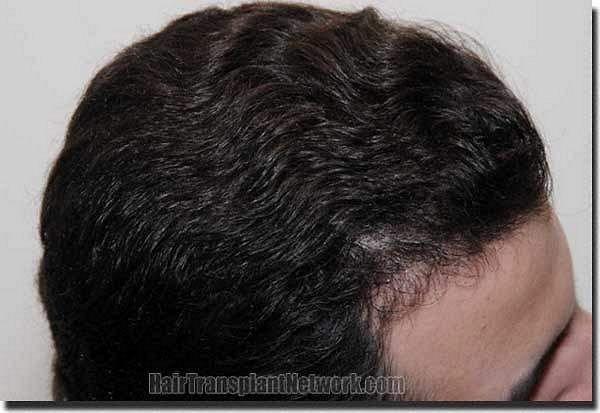 Hair restoration procedure results