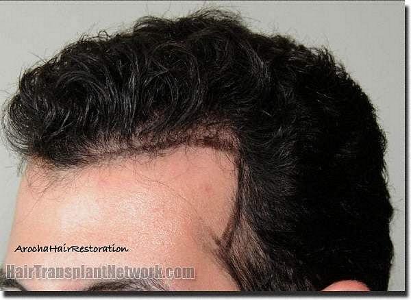 Hair restoration procedure results