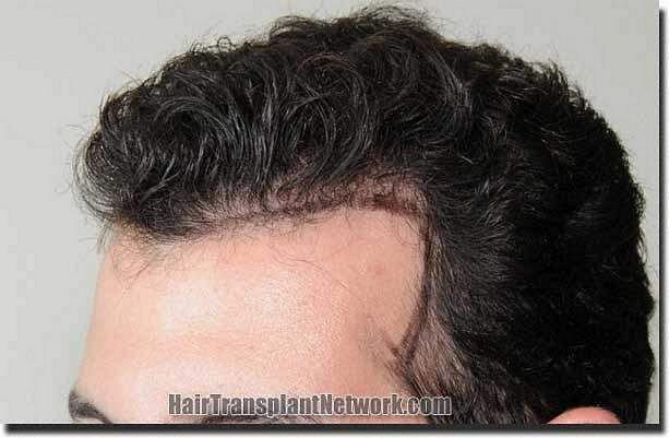 Hair restoration procedure results