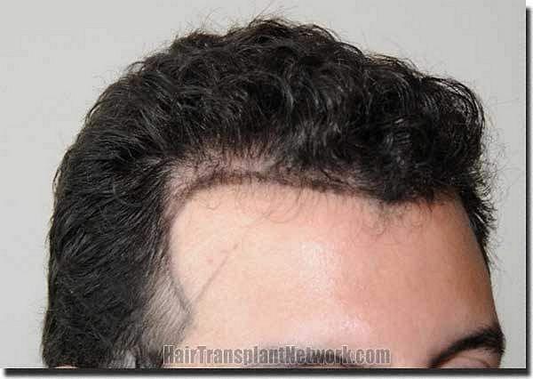 Hair restoration procedure results