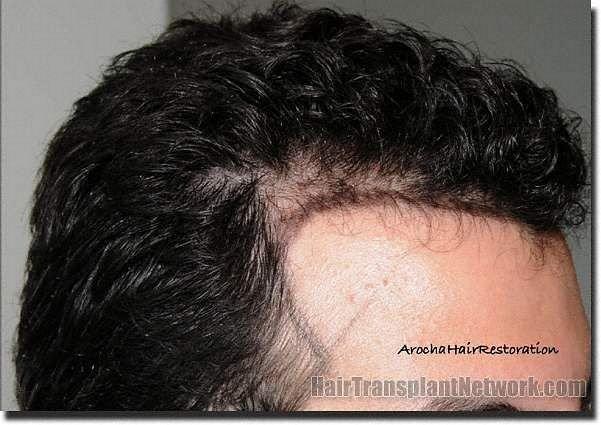 Hair restoration procedure results