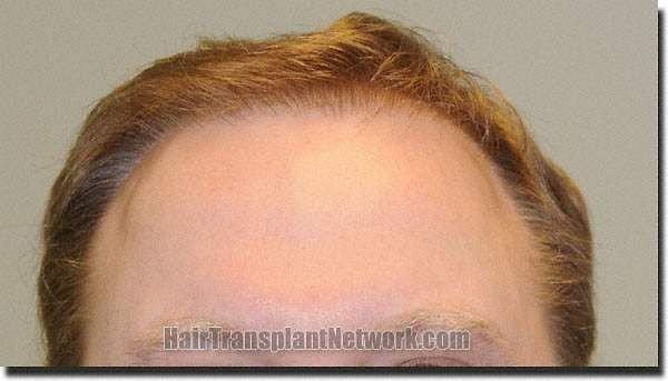 Hair restoration procedure results