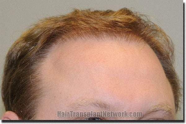 Hair restoration procedure results