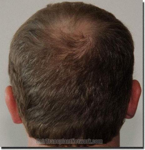 Hair restoration procedure results