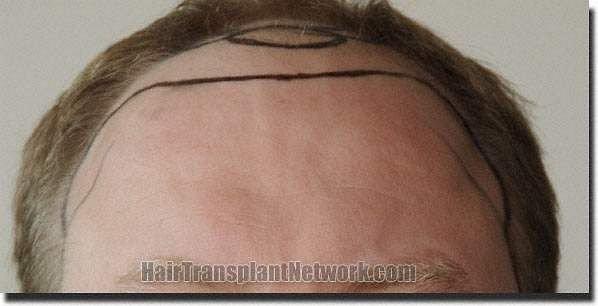 Hair restoration procedure results