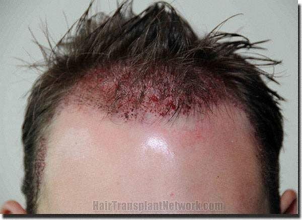 Hair restoration procedure results