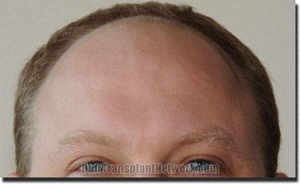 Hair restoration procedure results