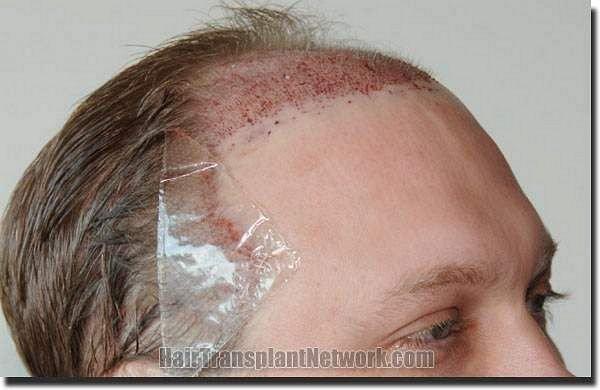 Hair restoration procedure results