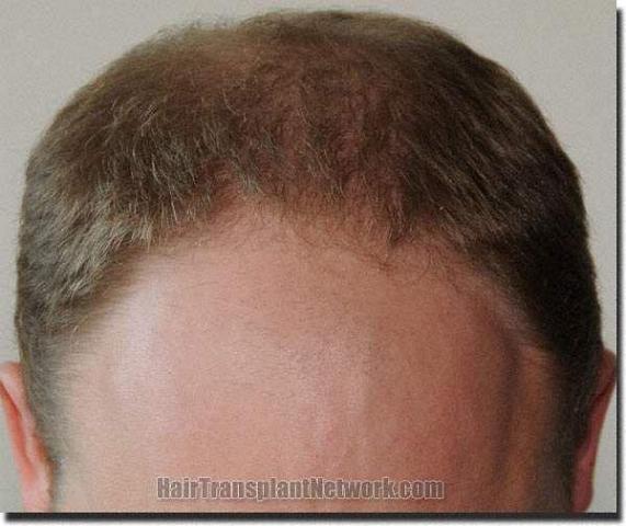 Hair restoration procedure results