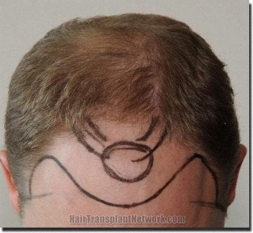 Hair restoration procedure results