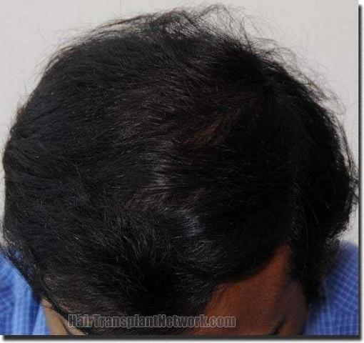 Hair restoration procedure results