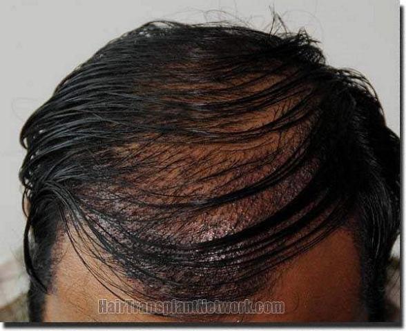 Hair restoration procedure results