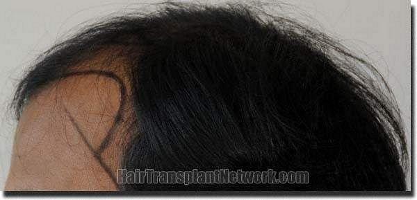 Hair restoration procedure results