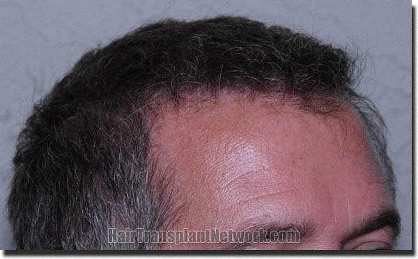 Hair restoration procedure results