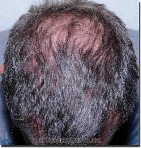 Hair restoration procedure results