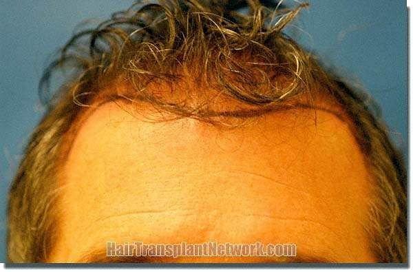 Hair restoration procedure results