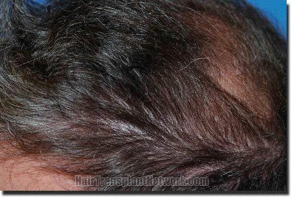 Hair restoration procedure results