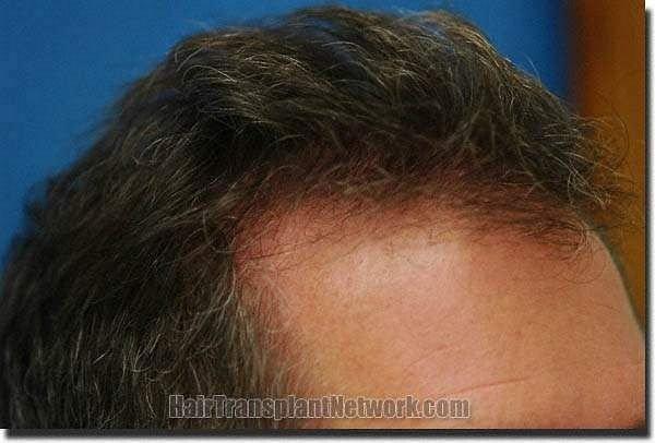 Hair restoration procedure results