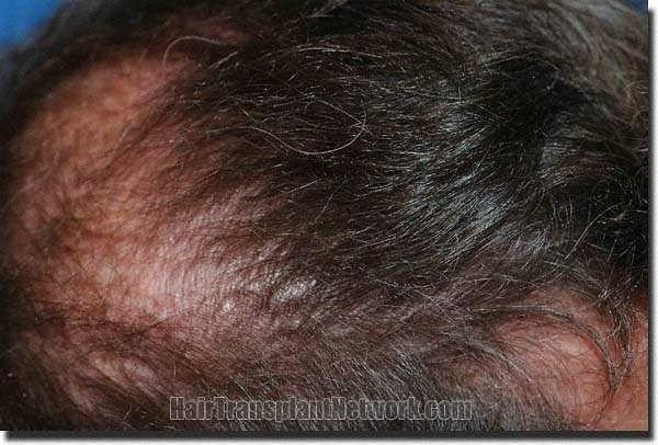 Hair restoration procedure results