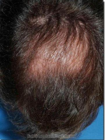 Hair restoration procedure results