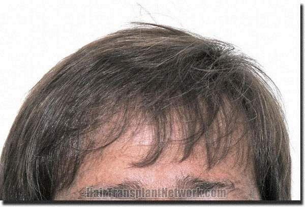 Hair restoration procedure results