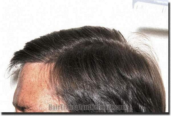 Hair restoration procedure results