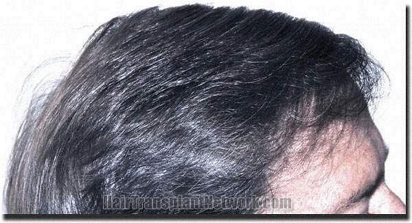 Hair restoration procedure results