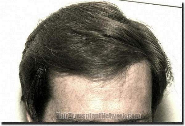 Hair restoration procedure results