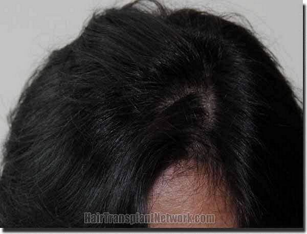 Hair restoration procedure results